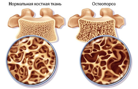 Сибирское здоровье кальций противопоказания